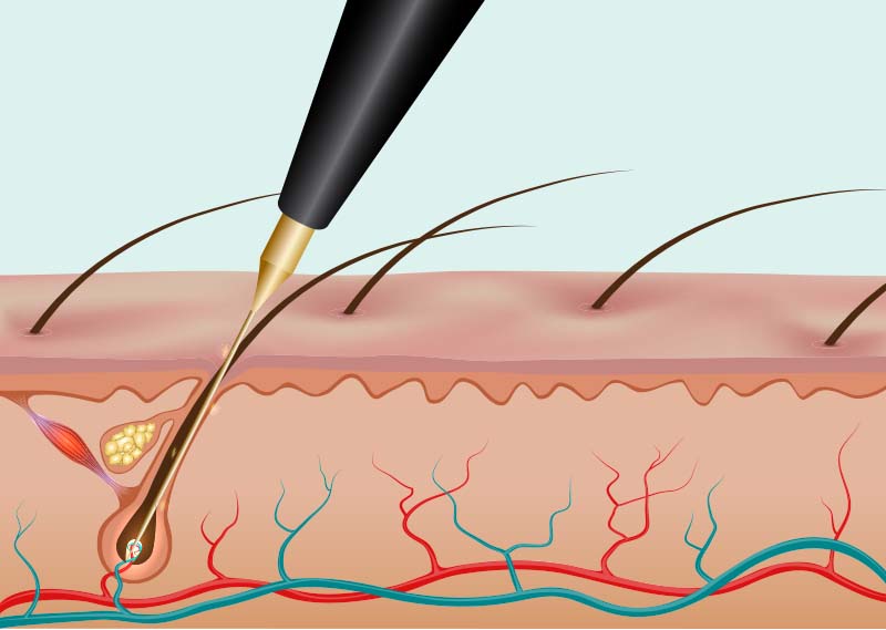 Electrolysis hair removal