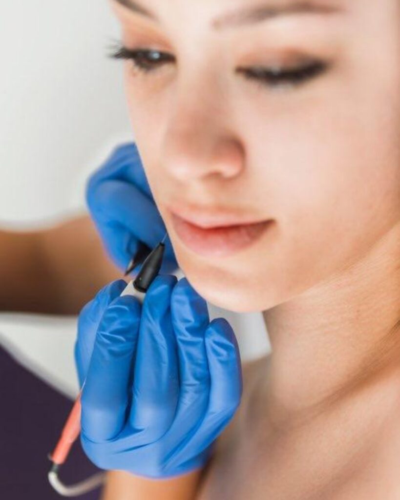 electrolysis hair removals