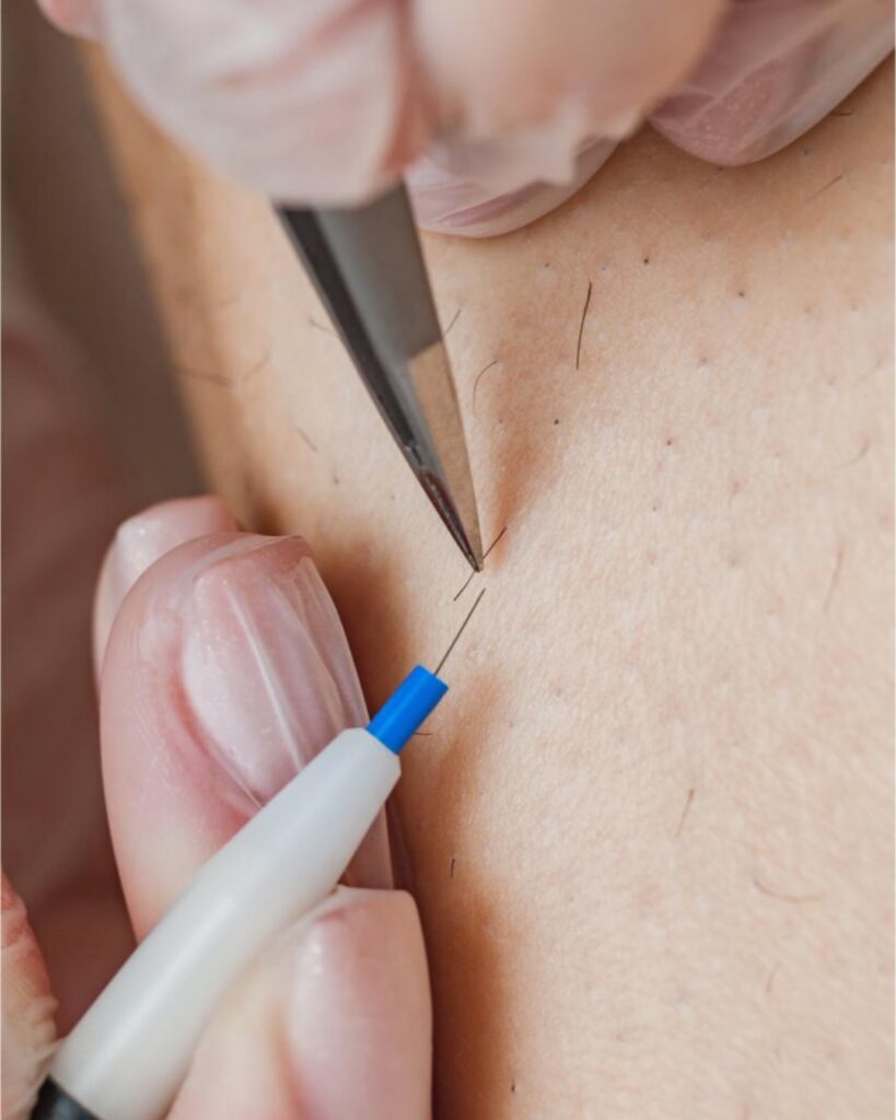 electrolysis hair removal